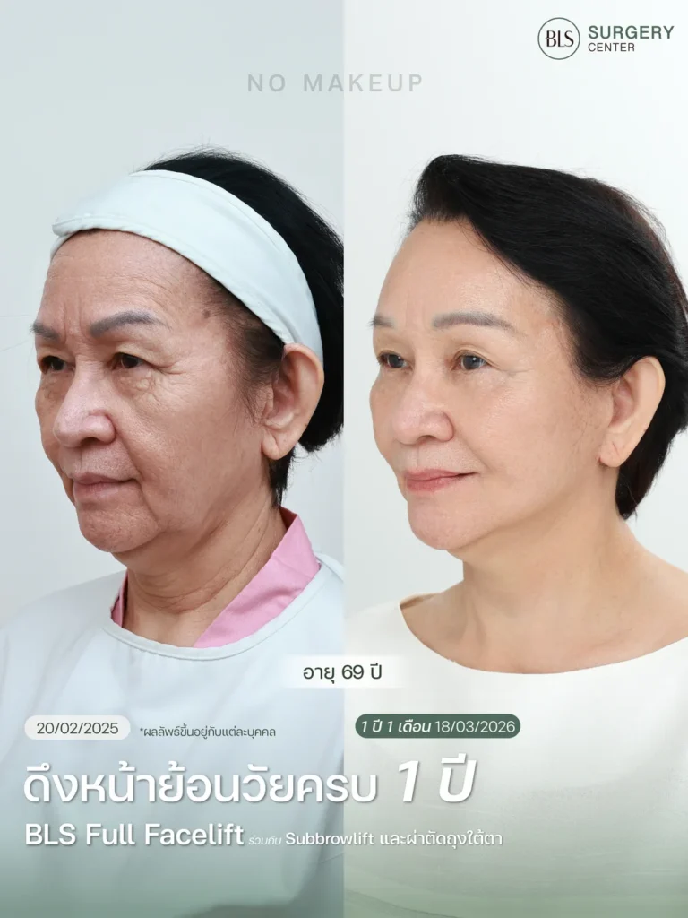 Necklift คืออะไร?