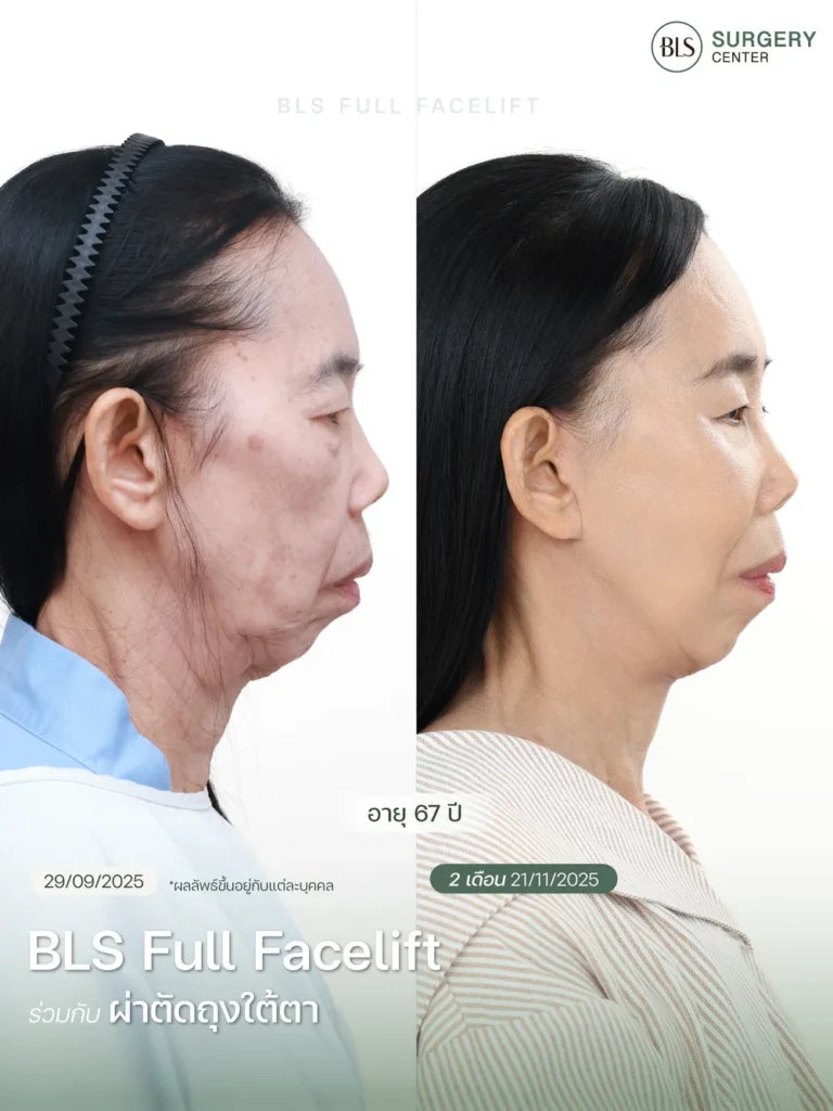 Necklift คืออะไร?