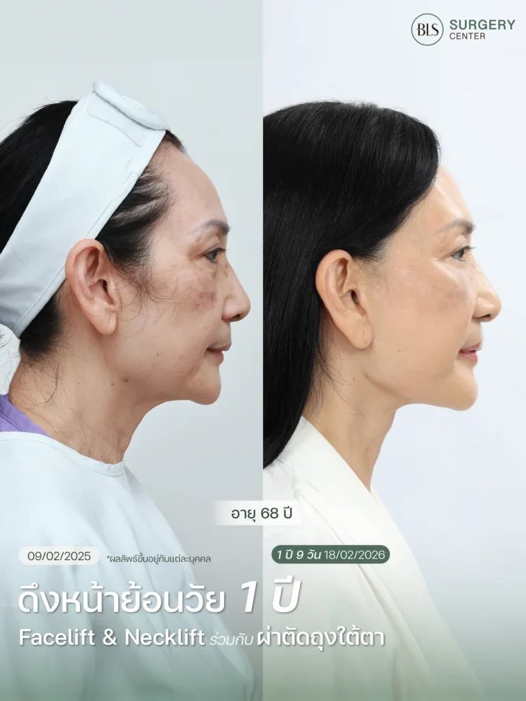 Necklift คืออะไร?