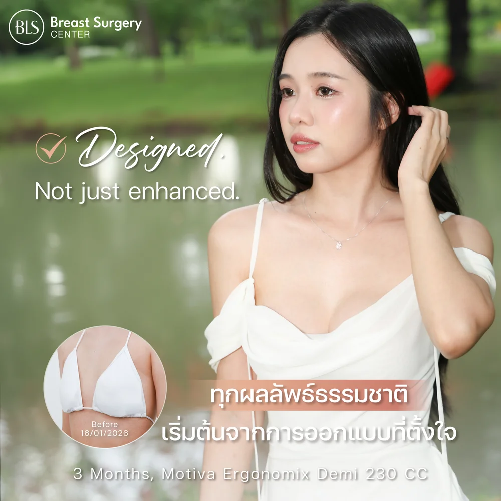 ทําหน้าอกที่ไหนดี อกสวยธรรมชาติ ด้วยซิลิโคน Motiva Ergonomix