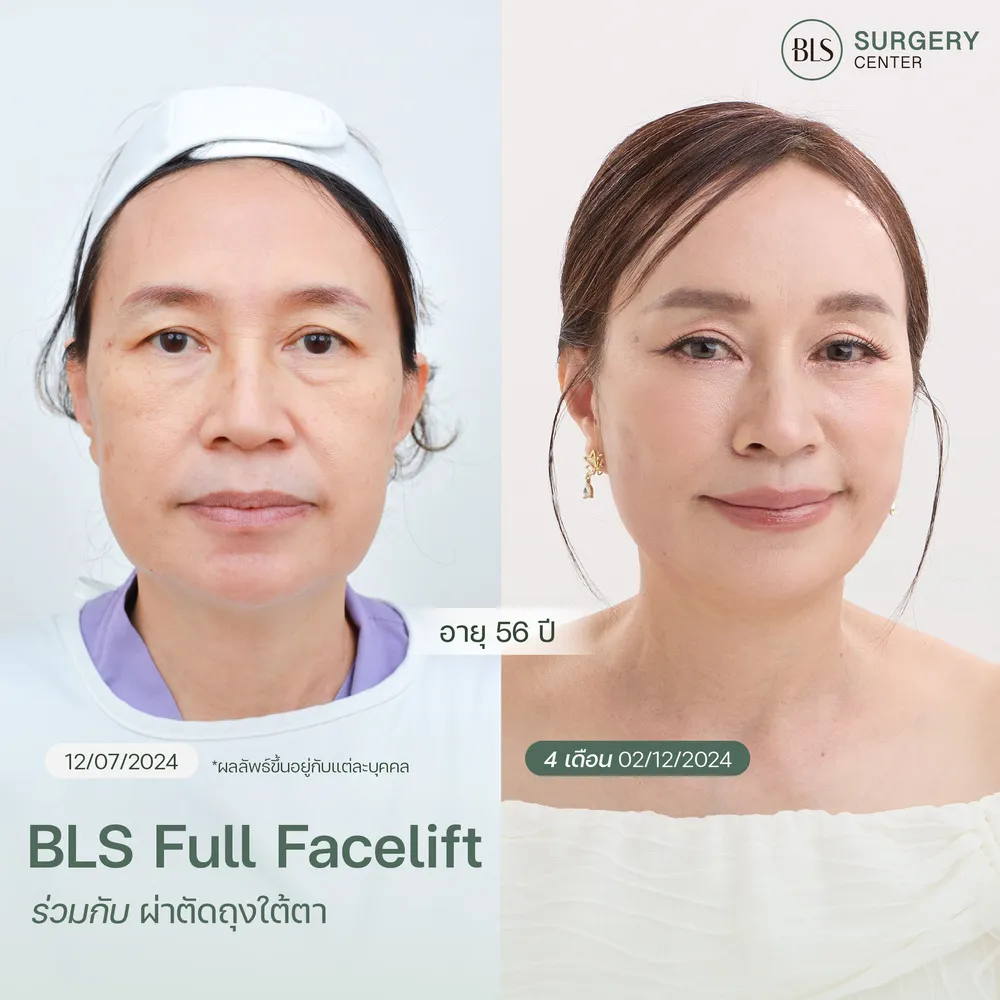 หมอเอิร์ธ BLS รีวิว BLS Full Facelift