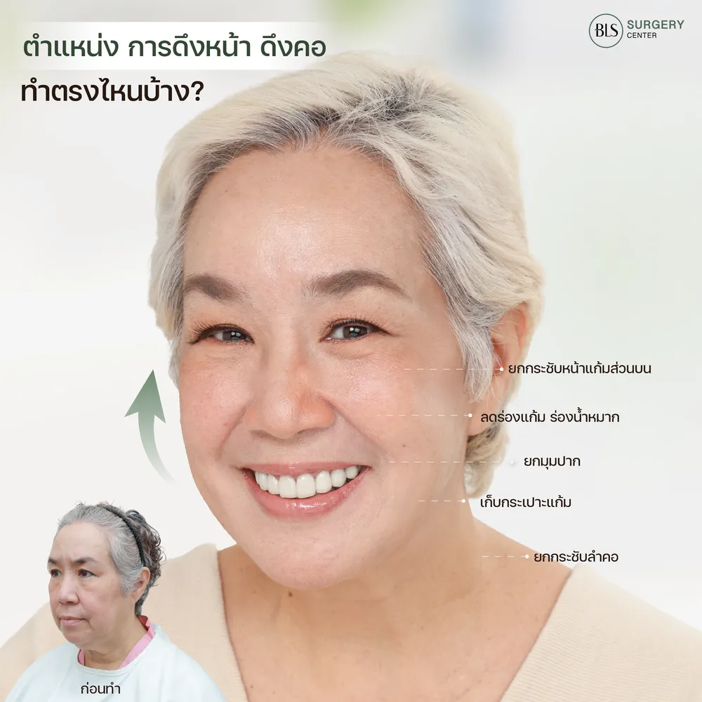 ดึงหน้าชั้นลึก ดึงหน้าดึงคอ โดยหมอเอิร์ธ Plastic Surgeon 