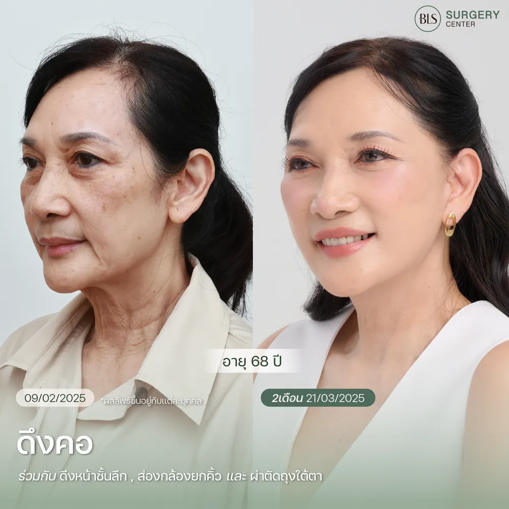 ดึงหน้าชั้นลึก ดึงคอ หมอเอิร์ธ Plastic Surgeon