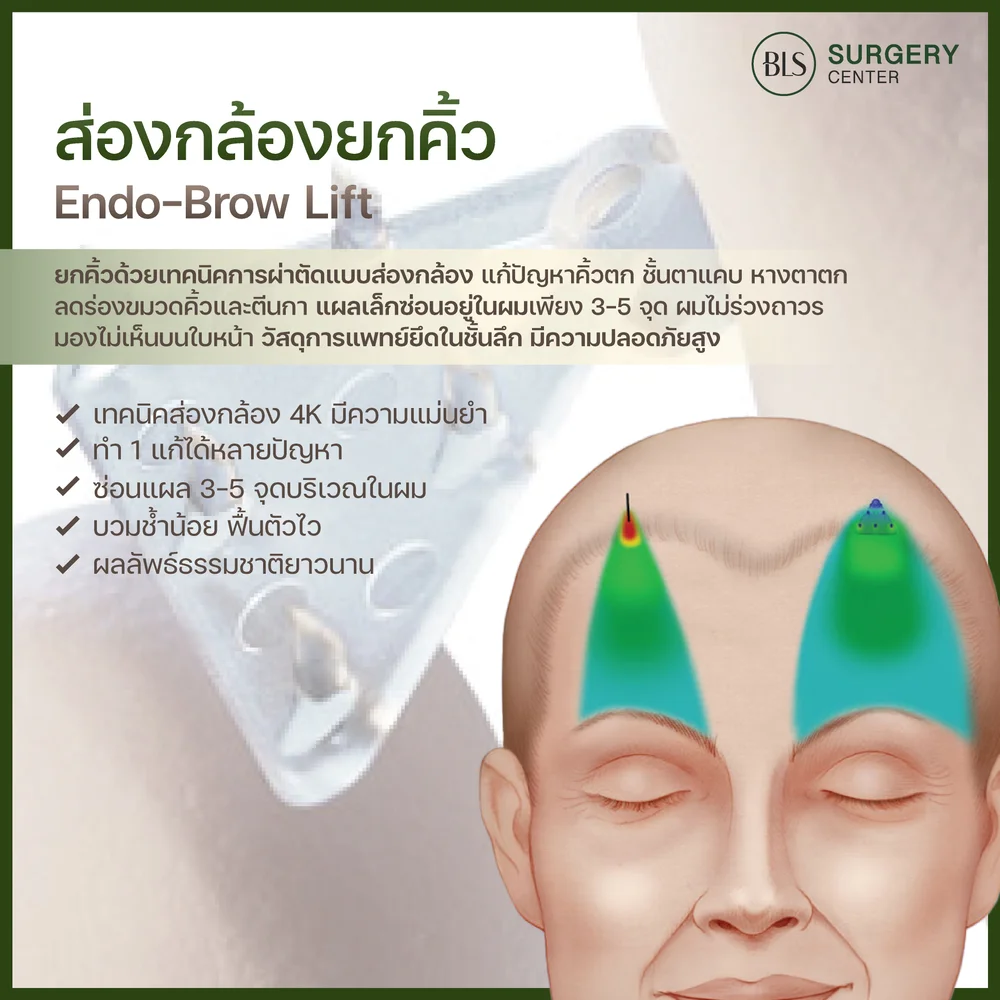 การส่องกล้องยกคิ้ว Endo-Brow Lift คืออะไร