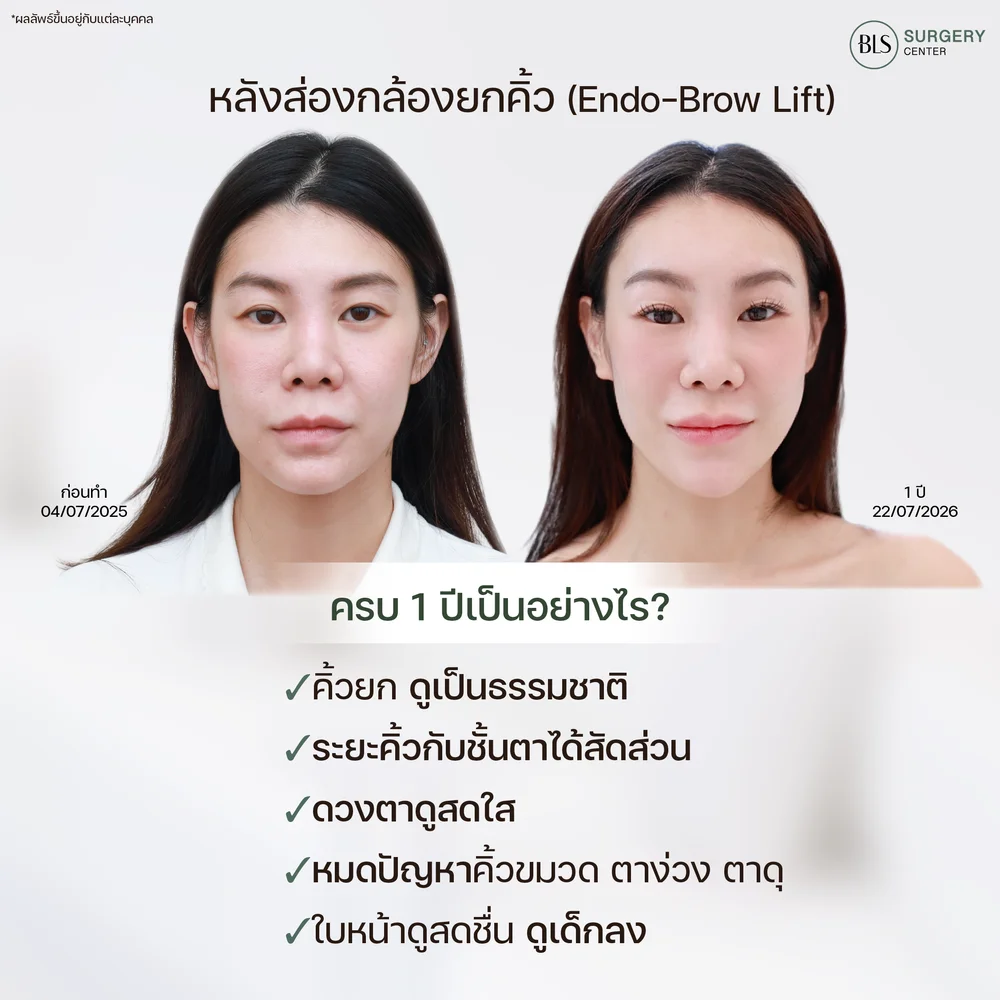 ส่องกล้องยกคิ้ว Endotine ครบ 1 ปี เป็นอย่างไร