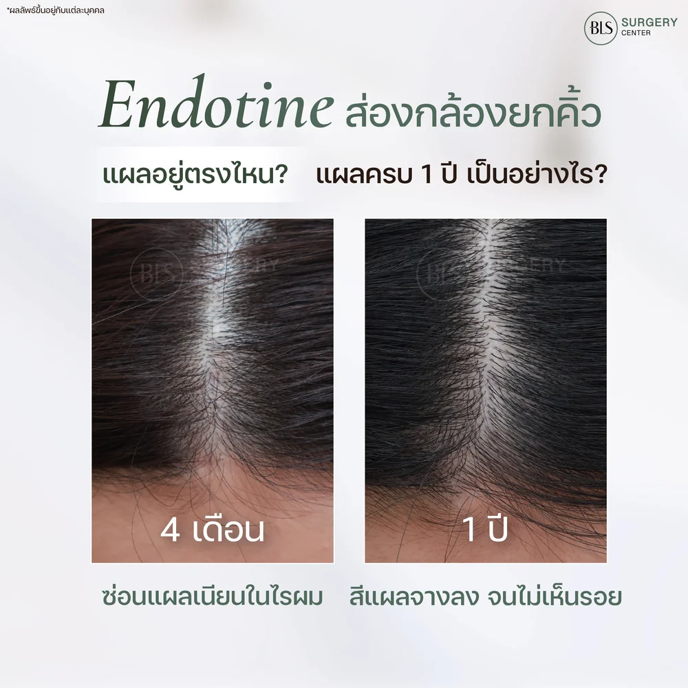 แผลส่องกล้องยกคิ้ว Endotine 4 เดือน vs 1 ปี