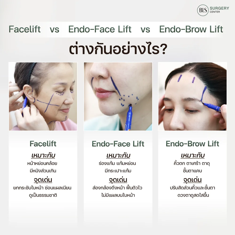 ดึงหน้า Facelift สำหรับผู้ที่มีหน้าหย่อนคล้อยและกรอบหน้าไม่ชัด