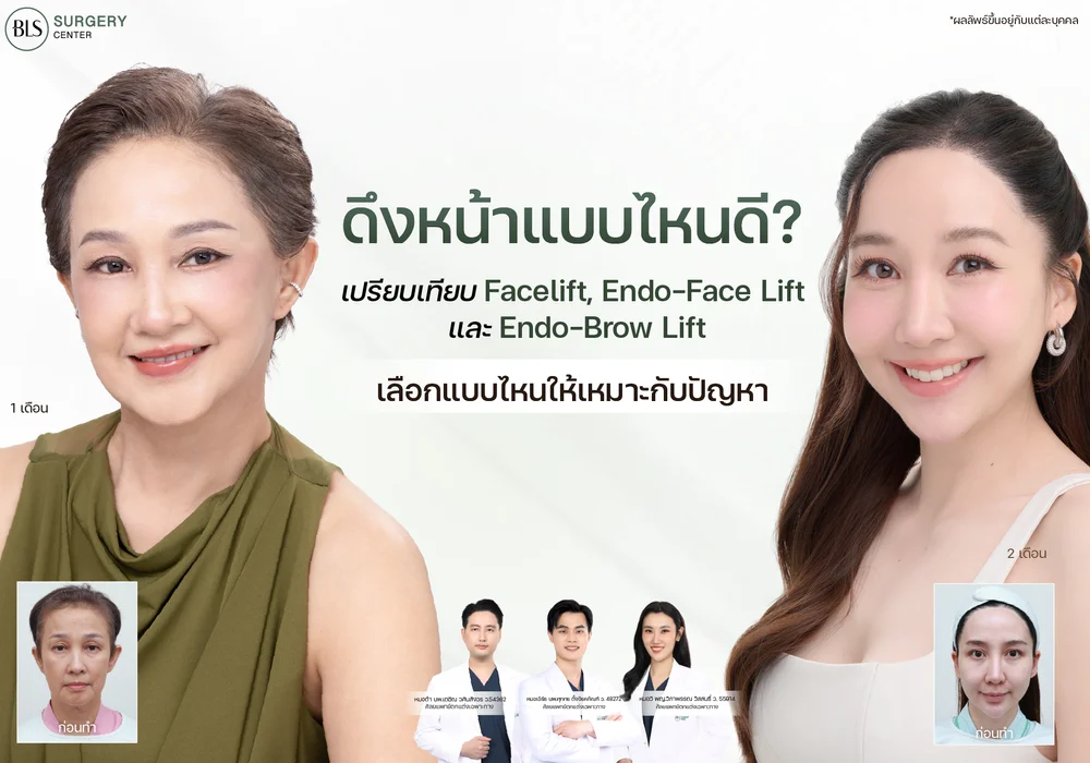 ดึงหน้าแบบไหนดี? เปรียบเทียบ Facelift, Endo-Face Lift และ Endo-Brow Lift เลือกแบบไหนให้เหมาะกับปัญหา