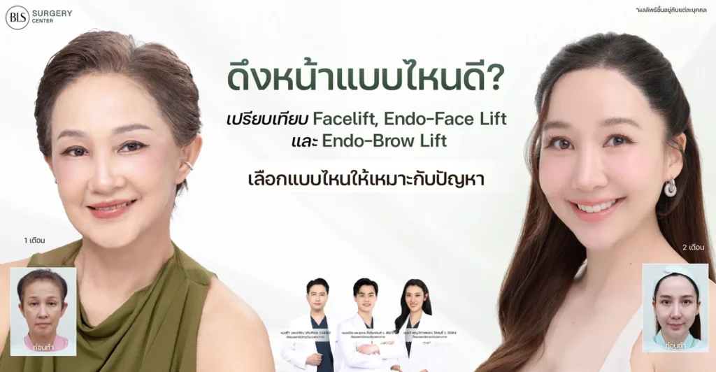 ดึงหน้าแบบไหนดี? เปรียบเทียบ Facelift, Endo-Face Lift และ Endo-Brow Lift เลือกแบบไหนให้เหมาะกับปัญหา