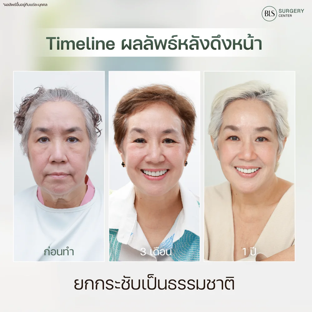 ศัลยกรรมดึงหน้ากี่วันเห็นผล Timeline ผลลัพธ์หลังดึงหน้า