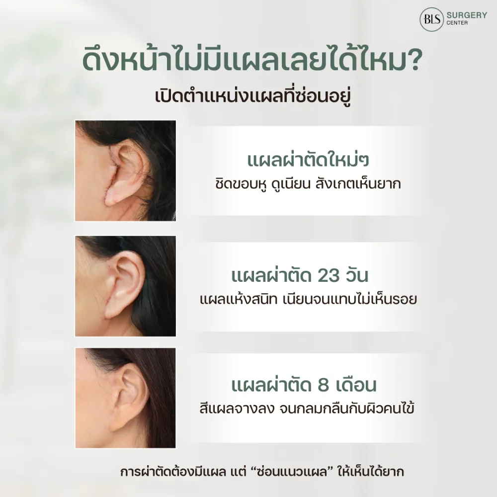 ดึงหน้าพักฟื้นกี่วัน แผลจากการดึงหน้า เป็นอย่างไร