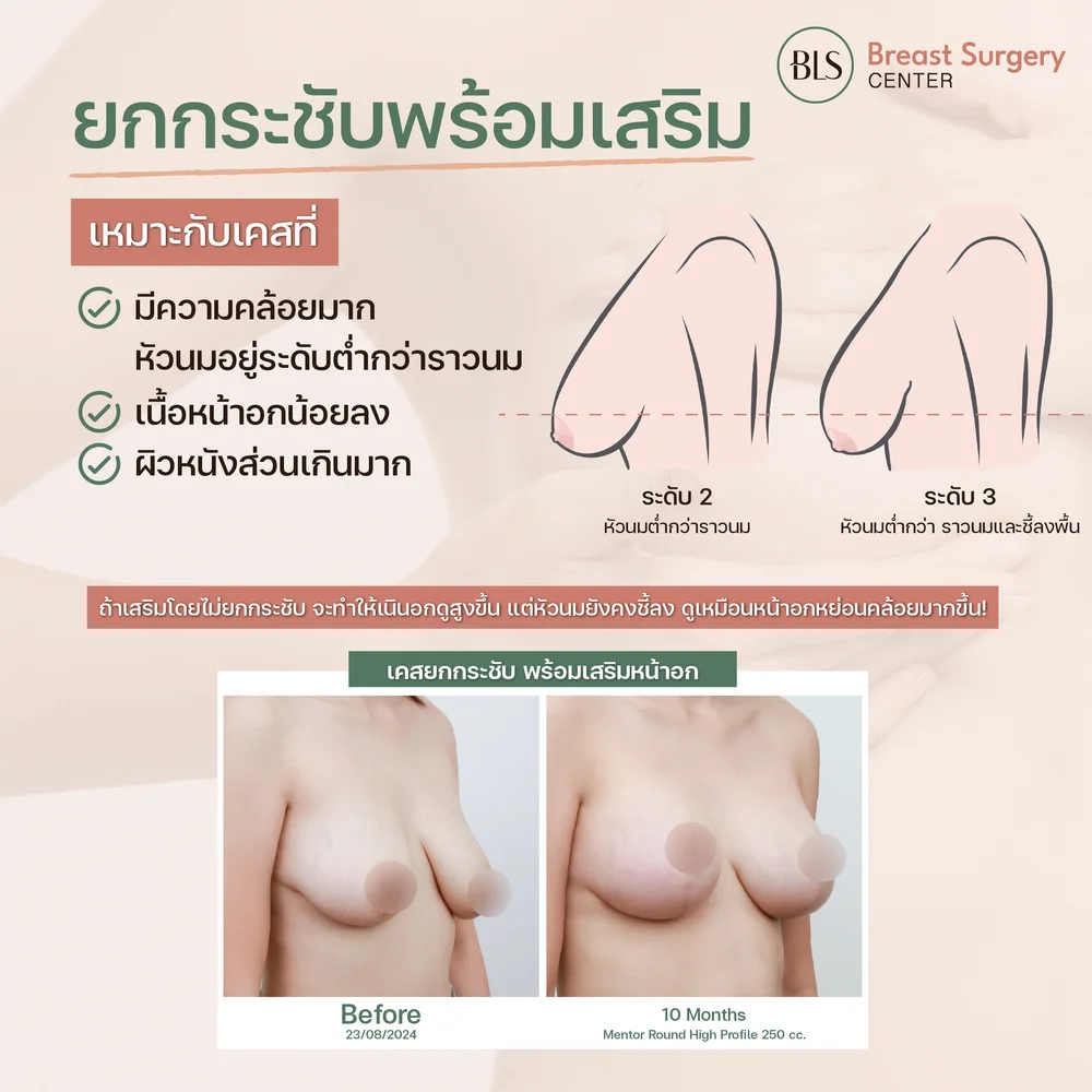 ยกกระชับหน้าอกหย่อนคล้อย เสริมหน้าอกซิลิโคน
