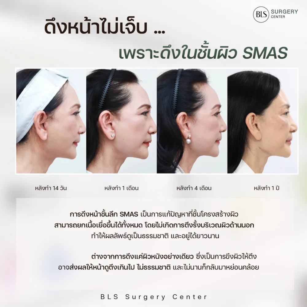  ดึงหน้าไม่เจ็บ เพราะดึงในผิวชั้น SMAS