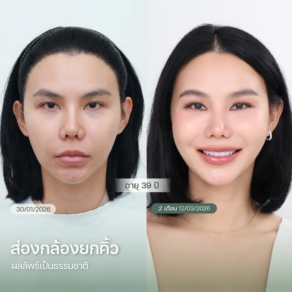 รีวิวการทำ Endotine ส่องกล้องยกคิ้ว