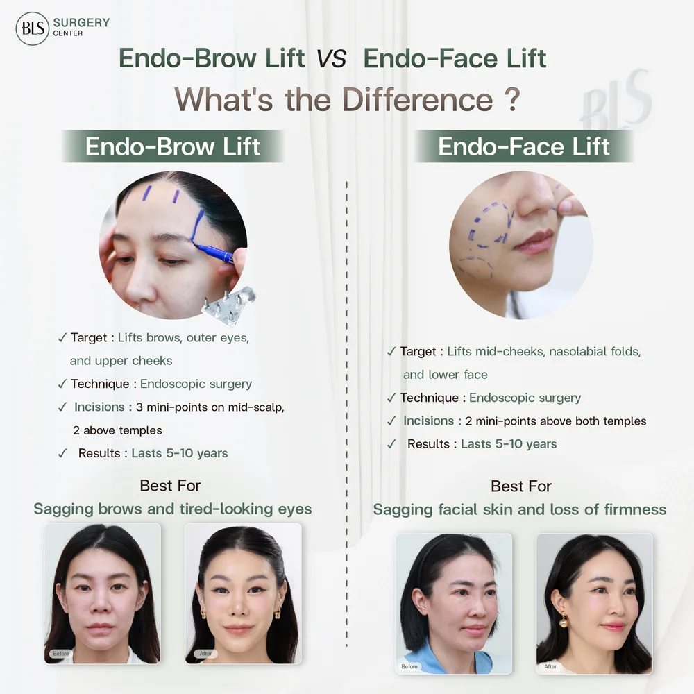 Types of Brow Lift Surgery: Endo-Brow Lift vs Endo-Face Lift