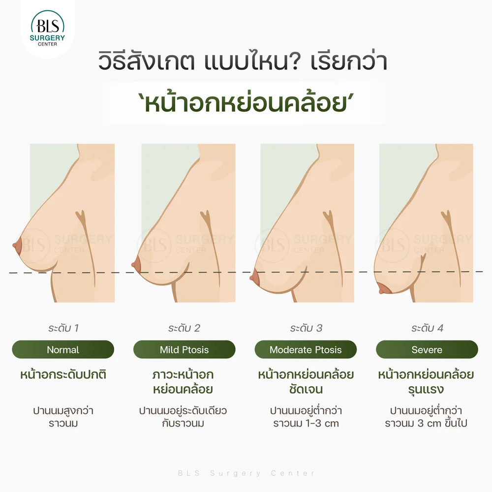 แบบไหนคือหน้าอกหย่อนคล้อย