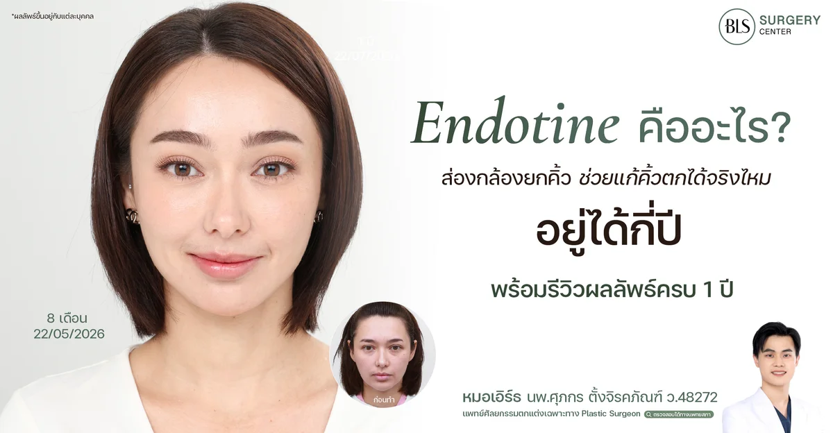 Endotine คืออะไร? ส่องกล้องยกคิ้วยกแก้คิ้วตกได้จริงไหม อยู่ได้กี่ปี พร้อมผลลัพธ์หลังทำครบ 1 ปี