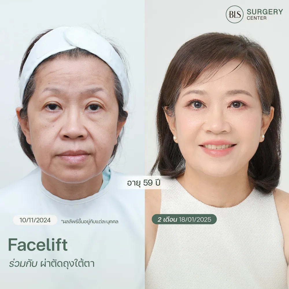 ดึงหน้าที่ไหนดี หมอเอิร์ธ BLS รีวิวดึงหน้า