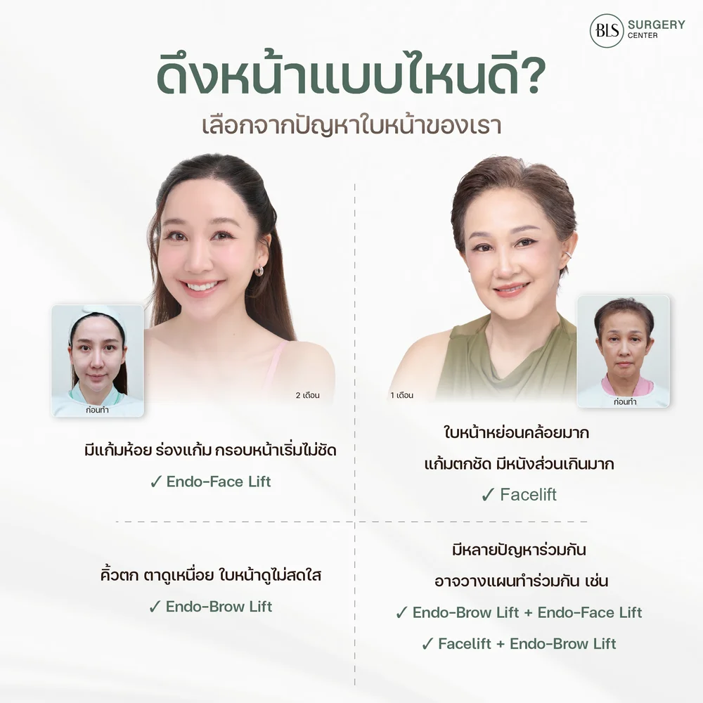 ดึงหน้าแบบไหนดี เปรียบเทียบ Facelift Endo-Face Lift และ Endo-Brow Lift ตามปัญหาใบหน้า