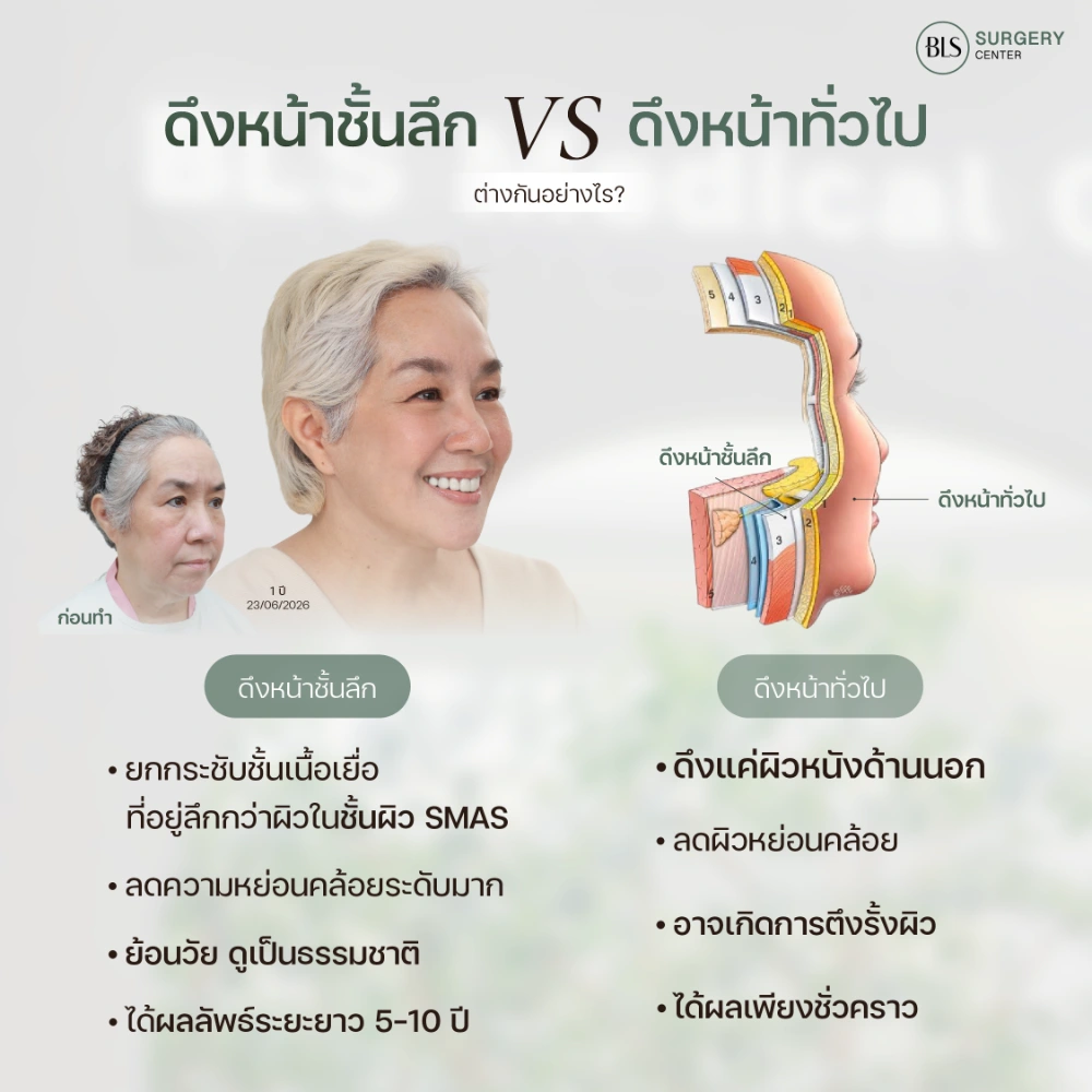 โครงสร้างใบหน้า 5 ชั้นและชั้น SMAS ก่อนการทำ Deep SMAS Facelift