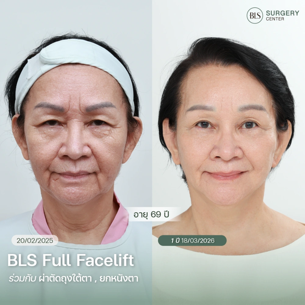 ดึงหน้าชั้นลึกเหมาะกับผู้ที่มีหน้าหย่อนคล้อยและกรอบหน้าไม่ชัด