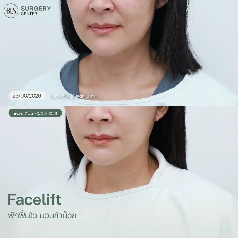 รีวิวดึงหน้า หมอต้า BLS