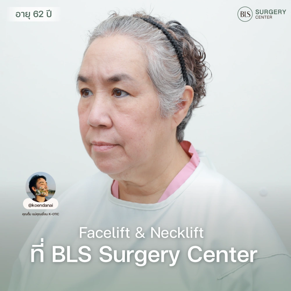 ดึงหน้าชั้นลึกอยู่ได้นานไหม ผลลัพธ์ Deep SMAS Facelift และการดูแลหลังผ่าตัด