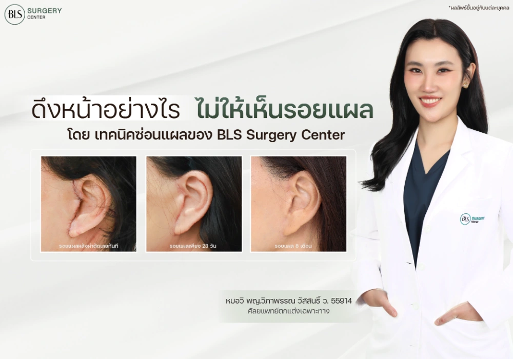 ดึงหน้าไม่มีแผลเลยได้ไหม? หมอวิ BLS ไขข้อสงสัยเรื่อง “แผลดึงหน้า” และเทคนิคซ่อนแผลให้เนียนเป็นธรรมชาติ
