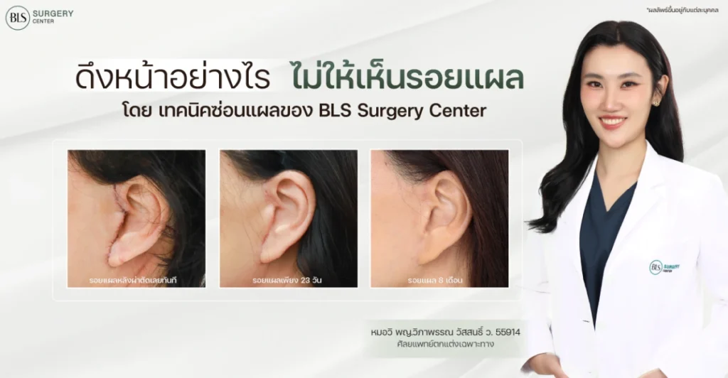 ดึงหน้าไม่มีแผลเลยได้ไหม? หมอวิ BLS ไขข้อสงสัยเรื่อง “แผลดึงหน้า”
และเทคนิคซ่อนแผลให้เนียนเป็นธรรมชาติ