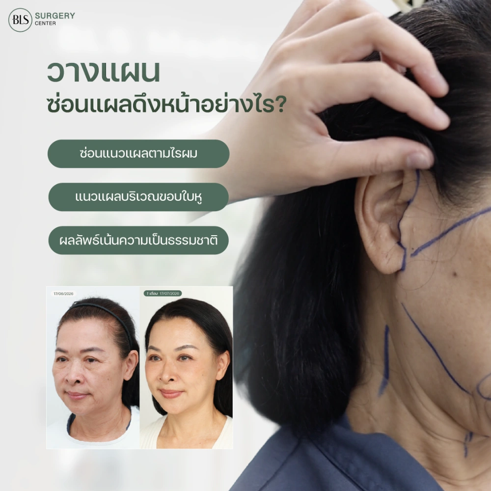 หมอวิ BLS ดึงหน้าผลลัพธ์ธรรมชาติ