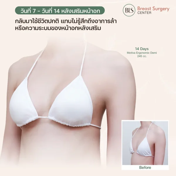 ทำหน้าอกมากี่วันขับรถได้?