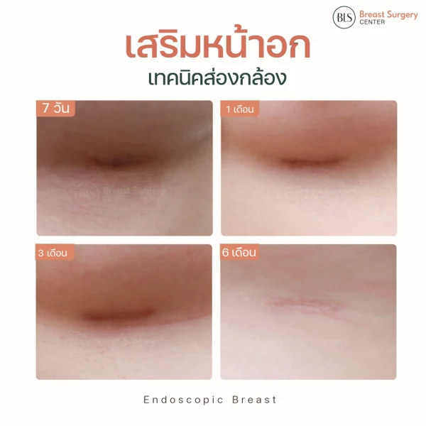 แผลผ่าตัดเสริมหน้าอก กี่เดือนหาย?